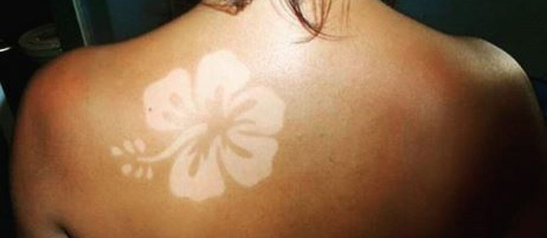 Sunburn Art, una tendencia en tatuajes muy peligrosa