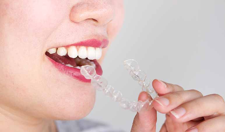 5 beneficios de la ortodoncia invisible - ¡Siéntete Guapa!