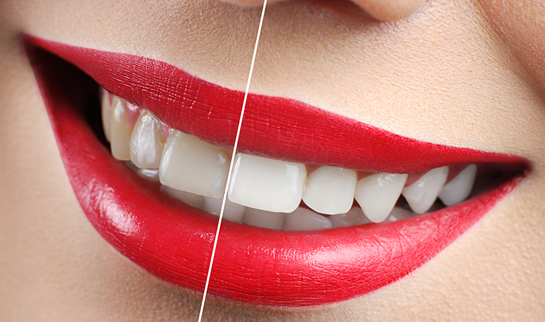 Cómo elegir las carillas dentales perfectas - ¡Siéntete Guapa!