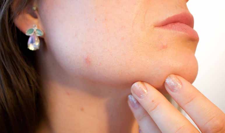 La piel y los granitos: cuida y limpia tu piel de forma sencilla y efectiva - ¡Siéntete Guapa!